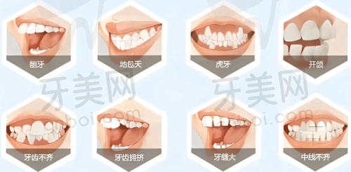 牙齿拥挤治疗实例分享