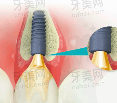 牙齿矫正技术