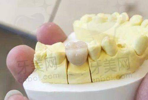 缺牙固定桥修复排名情况