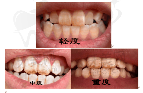牙齿医疗项目科普
