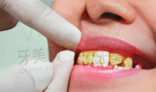 牙齿修复科普